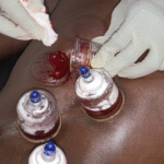 Qu’est-ce que la Hijama