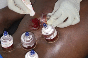 Qu’est-ce que la Hijama